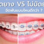 Orthodontics-จัดฟัน