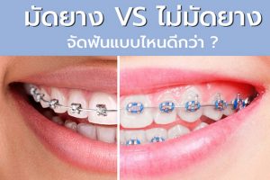 จัดฟัน แบบมัดยาง vs การจัดฟันแบบไม่มัดยาง แบบไหนดีกว่า