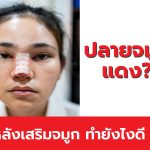ปลายจมูกแดง