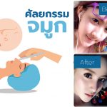ศัลยกรรมจมูก